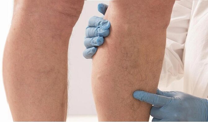 Doctors recommend Varicone for varicose veins