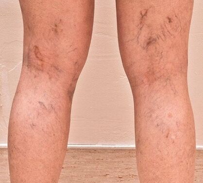 Varicose veins appeared on the legs