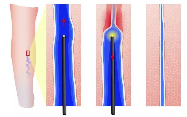 Electrocoagulation endovasal