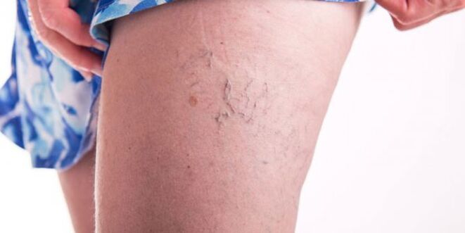 varicose veins in the legs