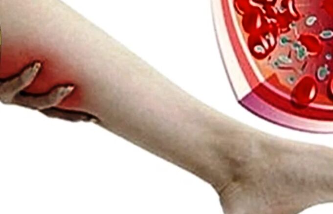 Varicose veins in the legs