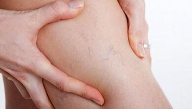 How the varicose veins are manifested