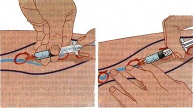 Methods for treating varicose veins