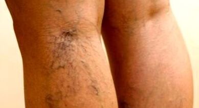 Effective way to treat varicose veins