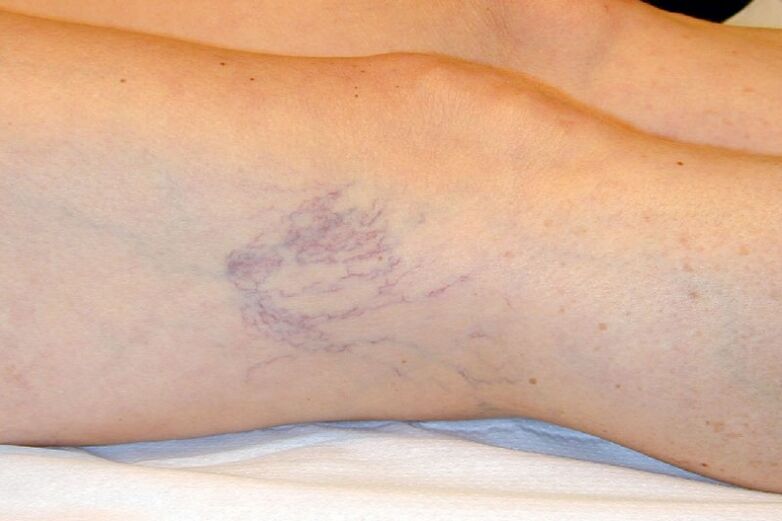 Stage C1 – reticular veins about 1 mm in diameter
