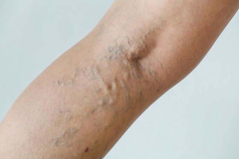 Stage C2 – popliteal varicose veins (perforator of Thierry) and reticular veins