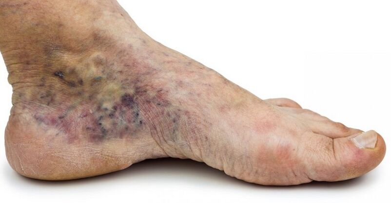 Stage C4c – crown of foot, phlebitis in center
