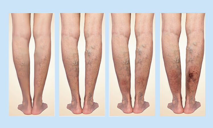 The phases of the vein with varicose